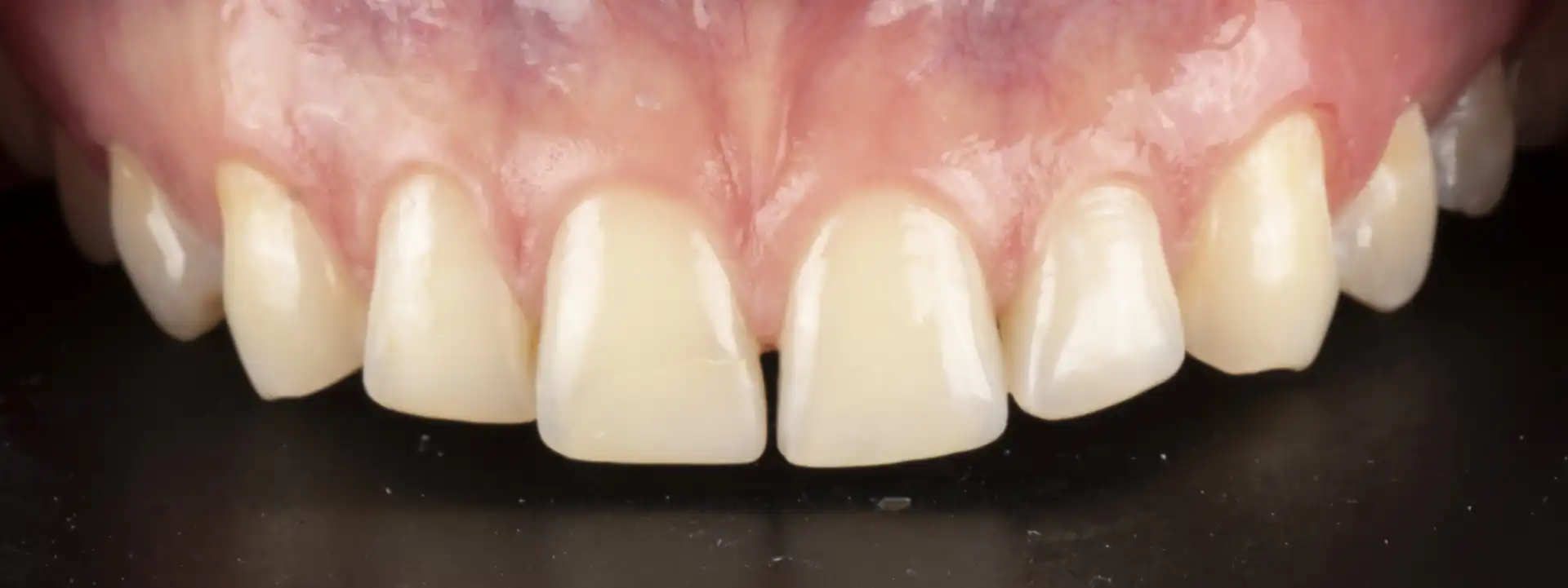 comparison picture of after the treatement case #2 - close up teeth only