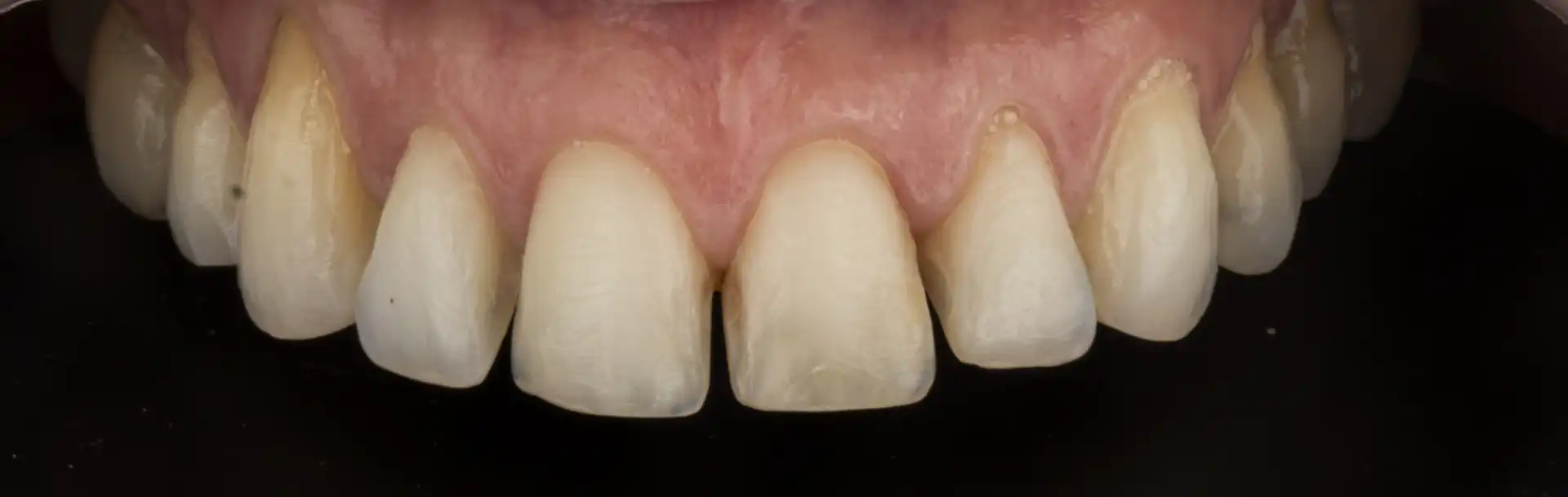 comparison picture of before case #1 - smile close up