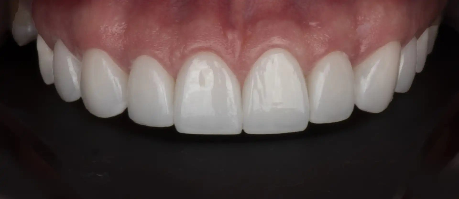 comparison picture of after the treatement case #2 - smile close up