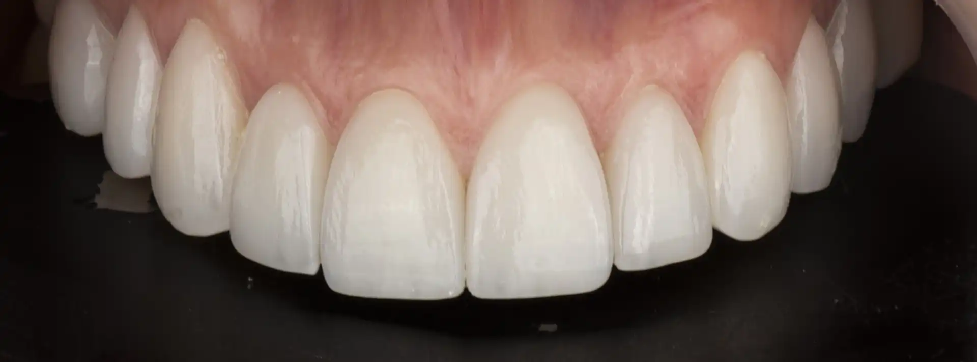 comparison picture of after the treatement case #1 - smile close up