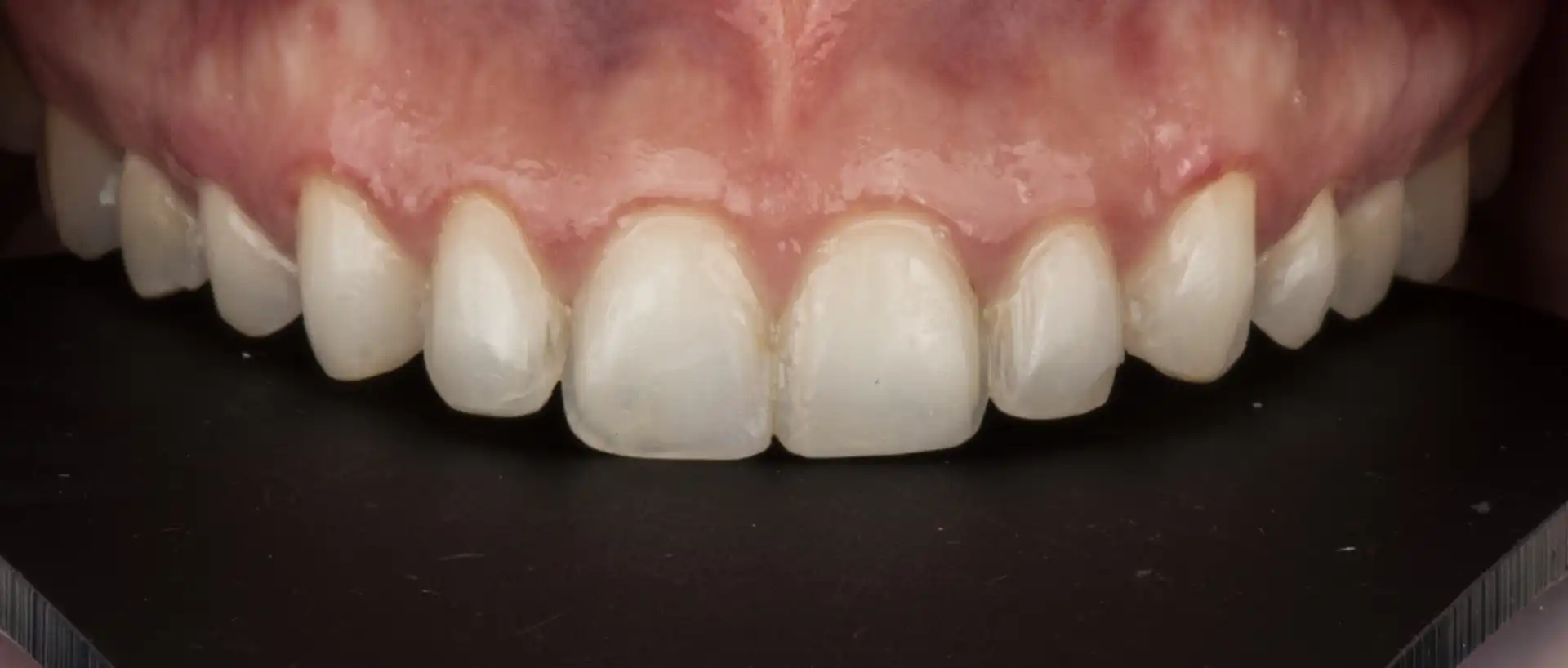 comparison picture of before case #3 - smile close up