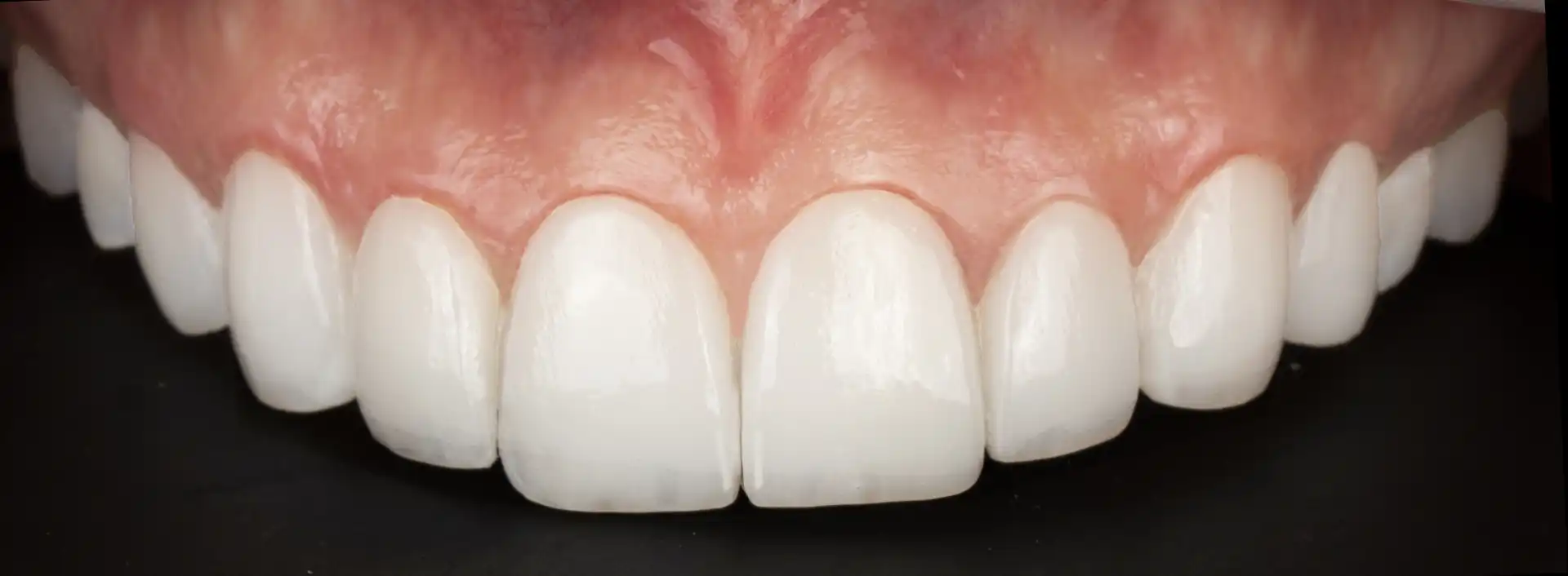 comparison picture of after the treatement case #3 - smile close up