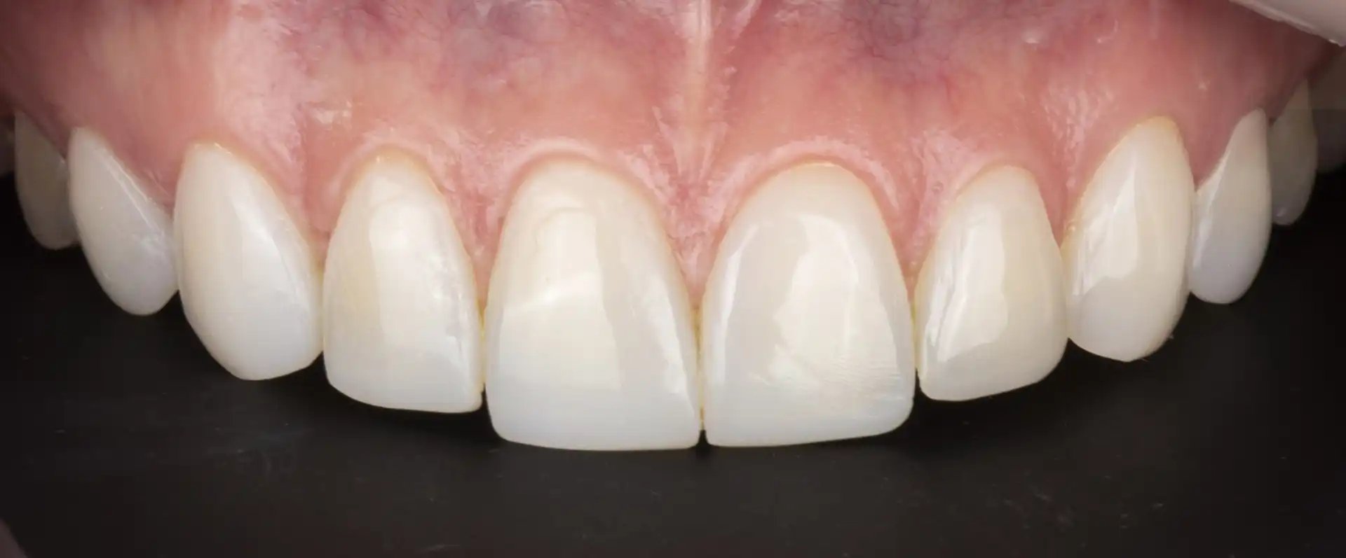 comparison picture of after the treatement case #2 - close up teeth only