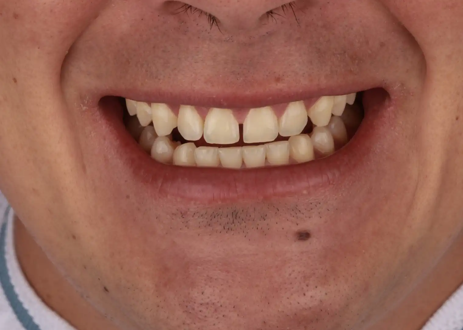 comparison picture of before case #1 - close up teeth only