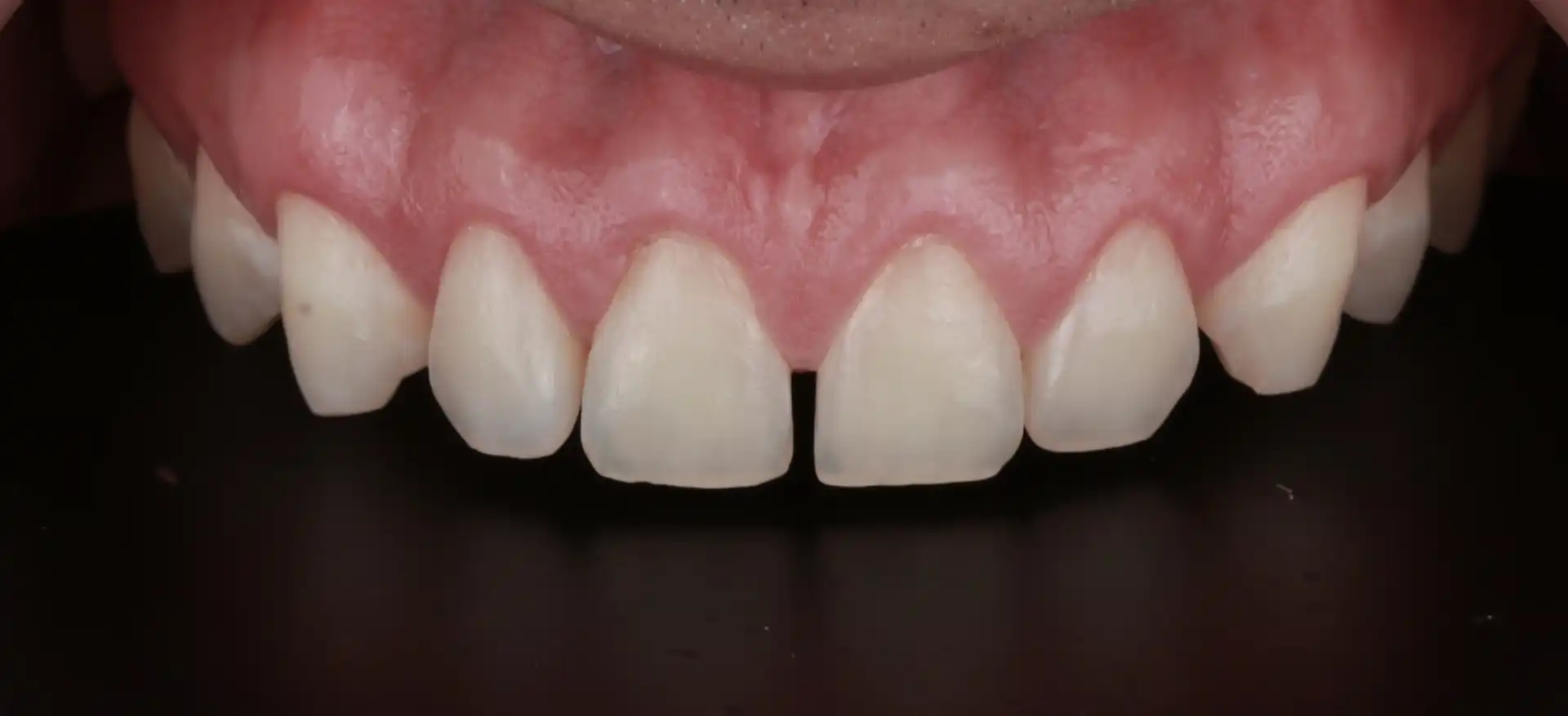 comparison picture of before case #2 - smile close up
